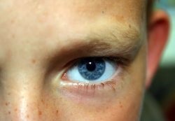 Pete pigmentate pe tipurile de ochi pleoapei, tratament