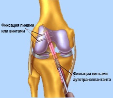 Plasticul articulațiilor genunchiului (bucăți)