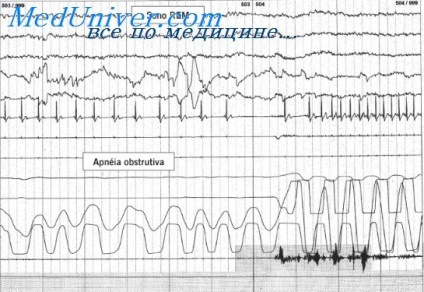 Efectele secundare ale amiodaronei asupra glandei tiroide