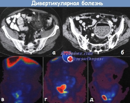 Indicatii si capabilitati ale tomografiei computerizate (CT) in coloproctologie