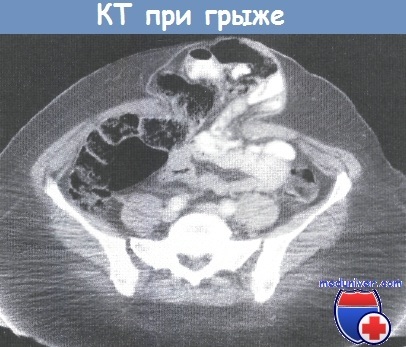 Indicatii si capabilitati ale tomografiei computerizate (CT) in coloproctologie