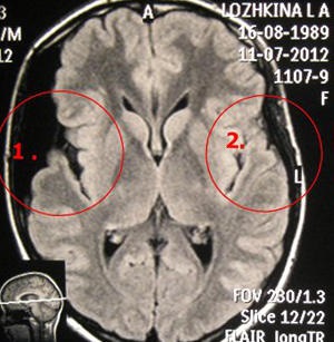 Efectele chistului arahnoid al creierului