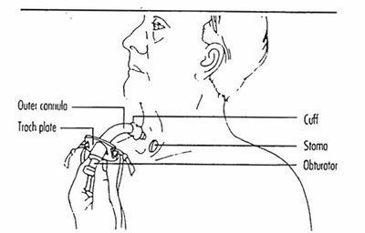 Kézikönyv képzés betegek gondozása a tracheostomiás cső