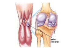 Preparate pentru tratamentul artrozei articulației genunchiului (video)