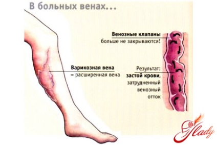 Semne de vene varicoase profunde