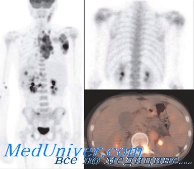 Metode de diagnosticare a radionuclizilor în hematologie - scintigrafie, tomografie cu emisie de pozitroni