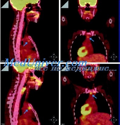 Metode de diagnosticare a radionuclizilor în hematologie - scintigrafie, tomografie cu emisie de pozitroni