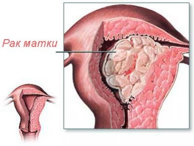 Cancerul fazei uterine, cat de repede se dezvolta si se trateaza