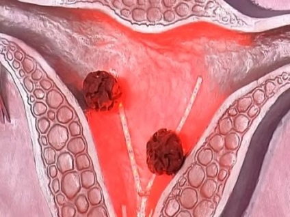 Cancerul fazei uterine, cat de repede se dezvolta si se trateaza