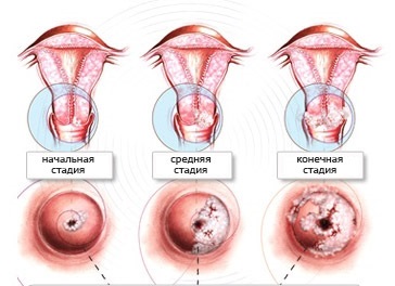 Cancerul fazei uterine, cat de repede se dezvolta si se trateaza