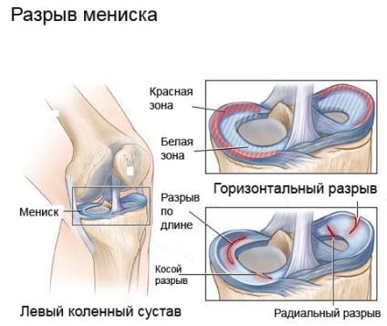 Ruptura meniscus, portal medical eurolab