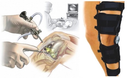 Reabilitarea după intervenția chirurgicală a genunchiului, așa cum a fost efectuată