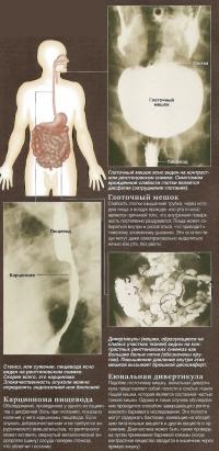 X-ray bárium szuszpenziójához (tudás - diagnosztika)