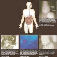 Suspensie de bariu de raze X (cunoștințe - diagnostice)