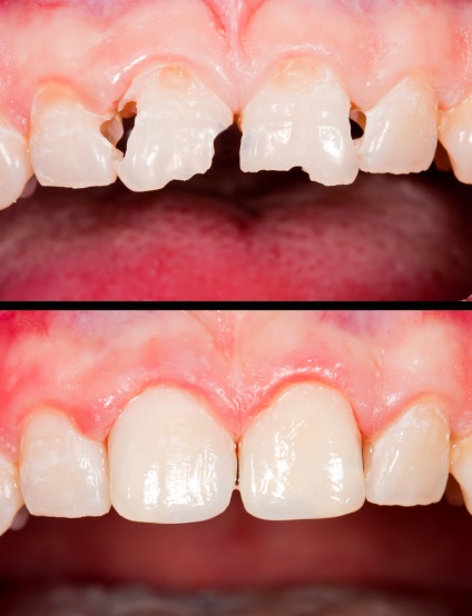 Restaurarea dinților cu materiale compozite - preț