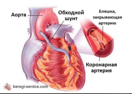 Măsurarea bolii și a bolilor de inimă la diabet zaharat (aritmie, angina pectorală și altele)