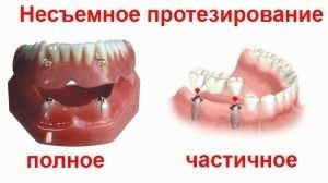 Metode moderne de proteze dentare