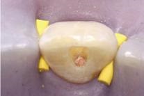 Articole despre endodonție, materiale și echipamente