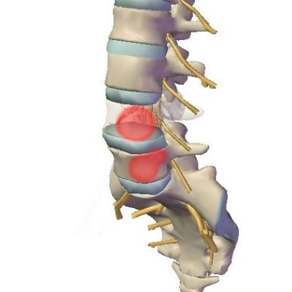 Merită să fie frică de hemangiomul coloanei vertebrale