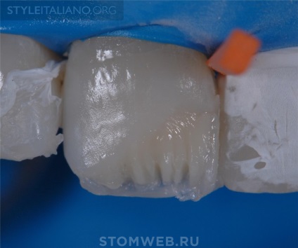 Stomweb - Cikk - tippek és trükkök, hogyan lehet a széleit pótlások az elülső fogak láthatatlan