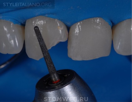 Stomweb - articol - sfaturi și sfaturi despre cum să faci marginile restaurărilor pe dinții din față invizibili