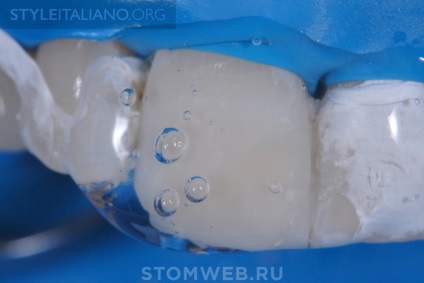 Stomweb - articol - sfaturi și sfaturi despre cum să faci marginile restaurărilor pe dinții din față invizibili