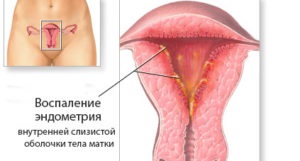 Întreruperea după menstruație (la sfârșitul menstruației, o săptămână mai târziu, în ultimele zile) este maro