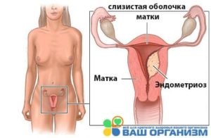 Întreruperea după menstruație (la sfârșitul menstruației, o săptămână mai târziu, în ultimele zile) este maro