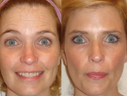 Botox injekciók - a múlt század! (Injekciók) Botox injekciók - a múlt század!