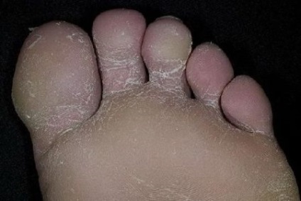 A gyermek oblazit bőr a lábujjak között (alakok) oka annak, hogy ezt