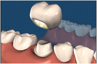 Instalarea coroanelor dentare în stomatologie denta plus în altufevo, cele mai bune prețuri pentru grămada de moscow