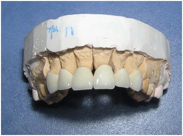 Instalarea coroanelor dentare în stomatologie denta plus în altufevo, cele mai bune prețuri pentru grămada de moscow