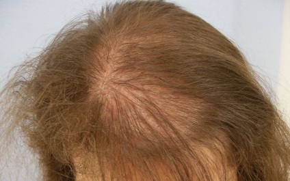 Căderea părului la femei și tratamentul la domiciliu, blog despre păr