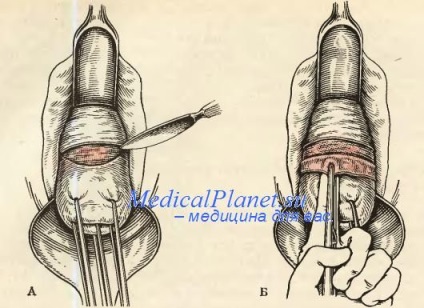 Extirparea vaginală a uterului de către meyo