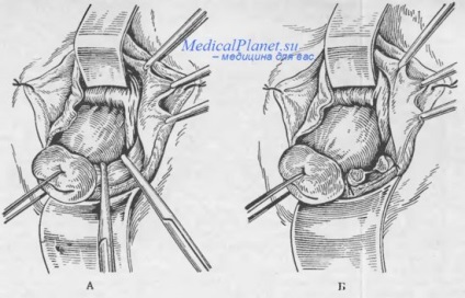 Extirparea vaginală a uterului de către meyo