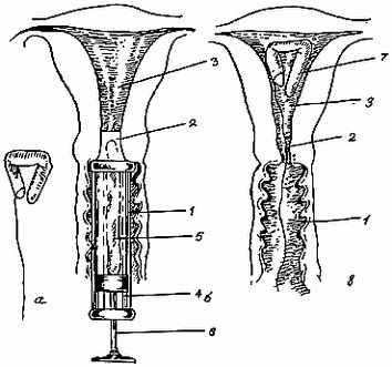 Forma intrauterină a spirală contraceptivă