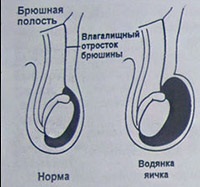 Dropsy of testicles (hidrocele), simptome, tratament și chirurgie - enciclopedia medicală