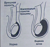 Hydrocele (hydrocele) tüneteit, a gyógyszerek és a sebészet - az orvosi enciklopédia