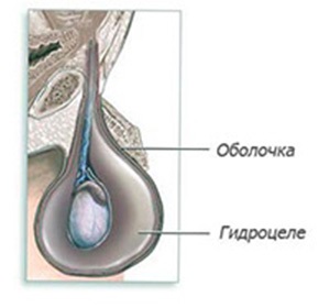 Dropsy of testicles (hidrocele), simptome, tratament și chirurgie - enciclopedia medicală
