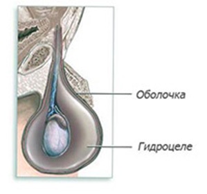 Hydrocele (hydrocele) tüneteit, a gyógyszerek és a sebészet - az orvosi enciklopédia