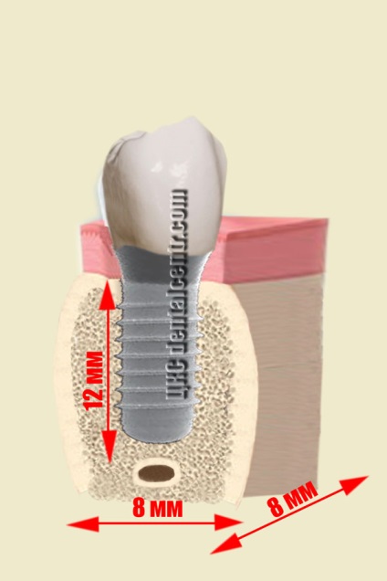 Az a lehetőség, a „gyógyulás” a fogászati ​​implantátumok