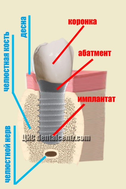 Posibilități de implantare a implanturilor dentare