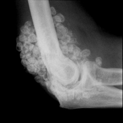 Chondromatosis, sport traumatológia