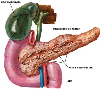 Pancreatită cronică, cum să trateze cauzele pancreasului, simptome, semne, tratament și
