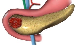 Pancreatită cronică, cum să trateze cauzele pancreasului, simptome, semne, tratament și