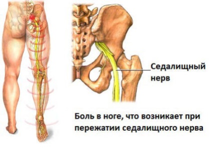 Strângerea nervului sciatic - cauze și tratament