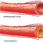 Tinnitus nyomás normális, a fej alacsony (nyomás) Tinnitus nyomás normális, a fej, az alacsony