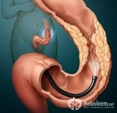 Adenocarcinomul stomacului, uterului, rectului