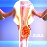 Adenocarcinomul stomacului, uterului, rectului