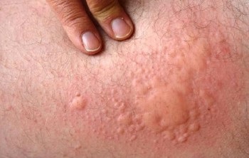 Grâu alergie - tipuri, cauze, tratament